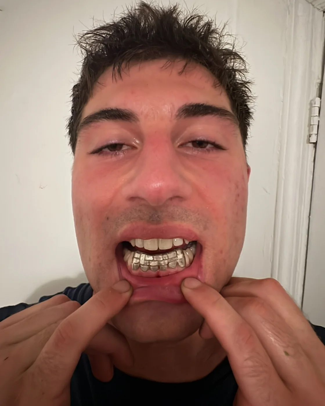 A client holding his lip down to show a full set of commissioned grillz